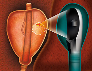 HIFU Treatment